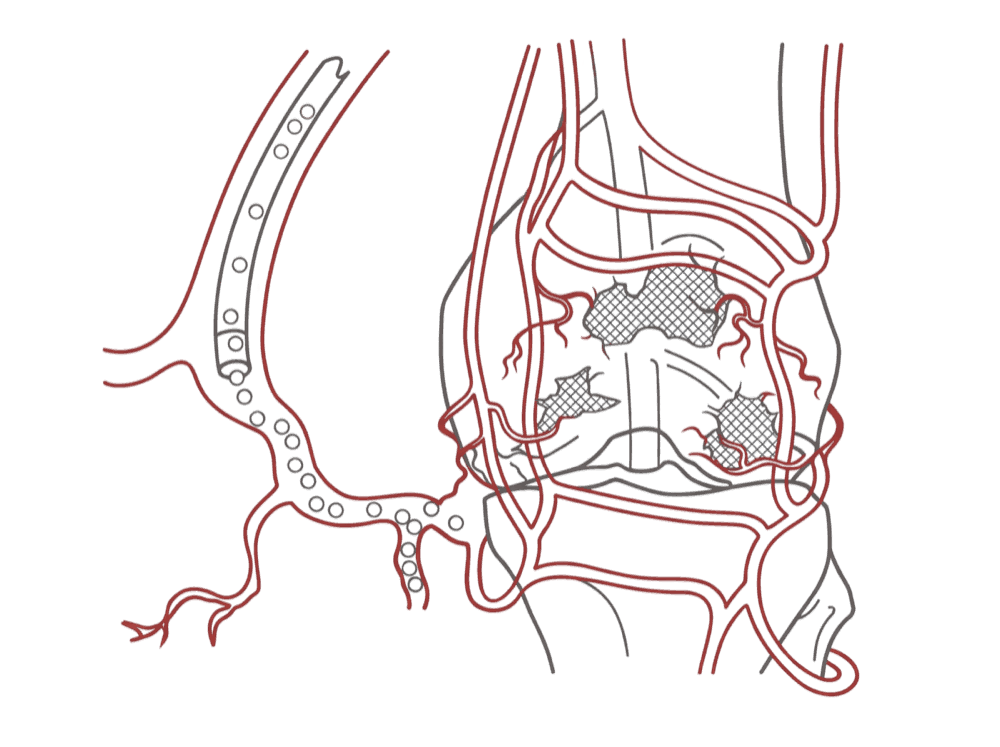 Genicular artery embolisation: a micro-catheter delivering embolic particles into the arteries supplying an inflamed, arthritic knee joint