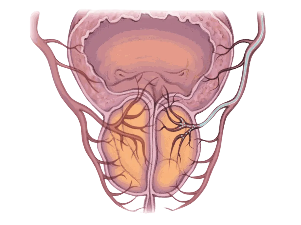 Illustration of an enlarged prostate constricting the urethra, with a micro-catheter reaching the prostatic arteries